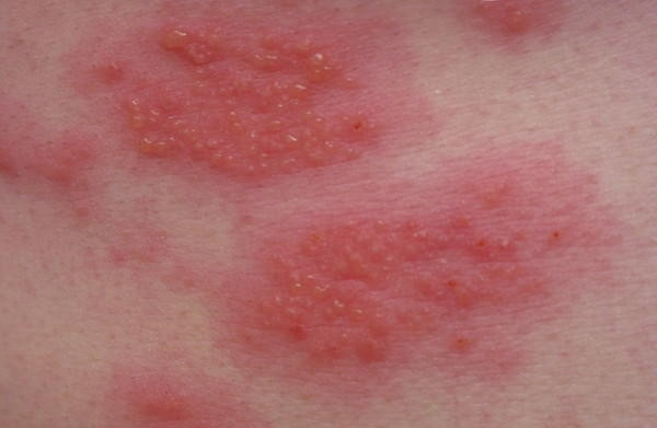  Viêm da tiếp xúc dị ứng Là một dạng bệnh về da trong mùa hè thường thấy. Đó là sự phản ứng của da khi tiếp xúc với chất nào đó gây dị ứng như: hóa chất, sản phẩm...