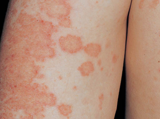 Các nốt màu hồng có thể xuất hiện ở nhiều nơi trên cơ thể như: Da, niêm mạc, tóc và móng. Bệnh nấm da thường gặp nhất là nấm chân, bẹn và thân tùy theo cơ địa của mỗi người. Mặc dù đây không phải là bệnh nguy hiểm nhưng nó thường rất dai dẳng, dễ tái phát và gây khó khăn trong điều trị. Hơn nữa, những lần mắc bệnh sau thường sẽ nặng và lâu dài hơn lần trước. Do đó, bệnh nhân cần được điều trị dứt điểm tận gốc ngay từ lần đầu tiên.