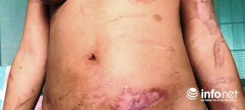 Chị Y Nhiêu bị đánh đập với hàng chục vết thương chi chít trên cơ thể.