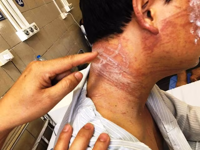 Bác sĩ chỉ cách phòng và sơ cứu sứa lửa cắn đúng nhất Bac si chi cach phong va so cuu sua lua can dung nhat