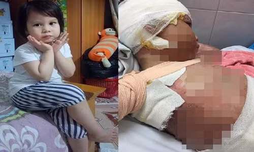 Co the bien dang cua be gai 5 tuoi bi bong con toan than