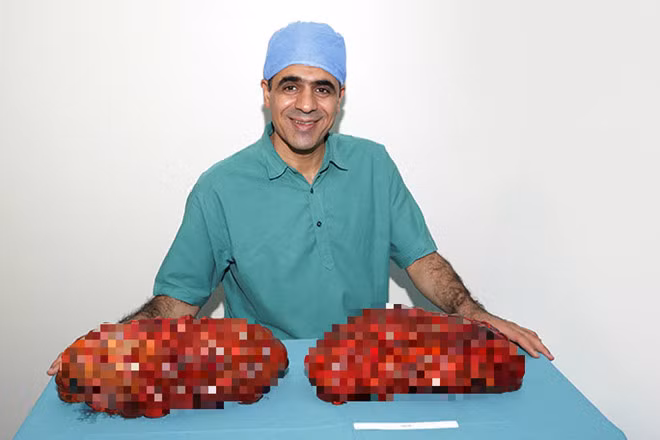 Cắt bỏ thành công quả thận lớn nhất thế giới Cat bo thanh cong qua than lon nhat the gioi