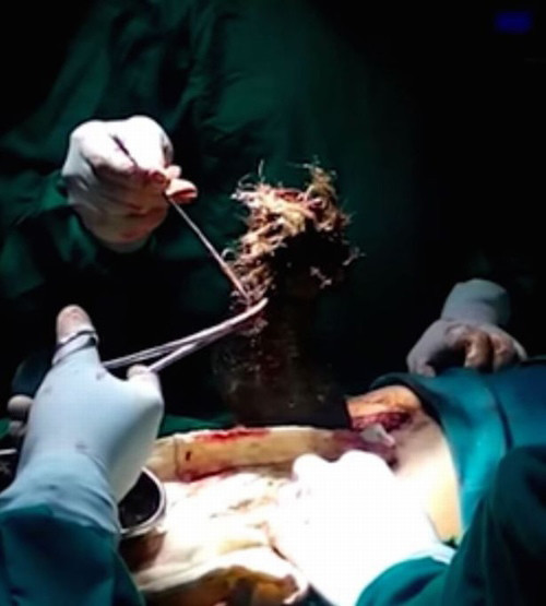 Ky la co be an toc trong suot 6 thang rong