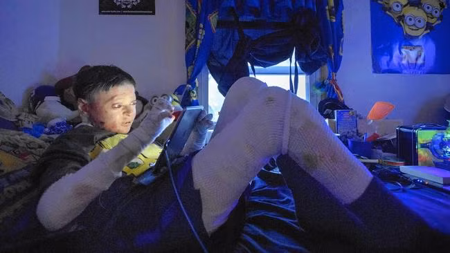 Jonathan Gionfriddo mắc chứng Bong biểu bì bullosa nặng khiến làn da của cậu sẽ bị bong tróc và sưng tấy khi tiếp xúc với đồ vật dù chỉ là nhẹ nhất. Chính vì vậy, cậu bé thường phải quấn băng kín người giống như xác ướp Ai Cập.