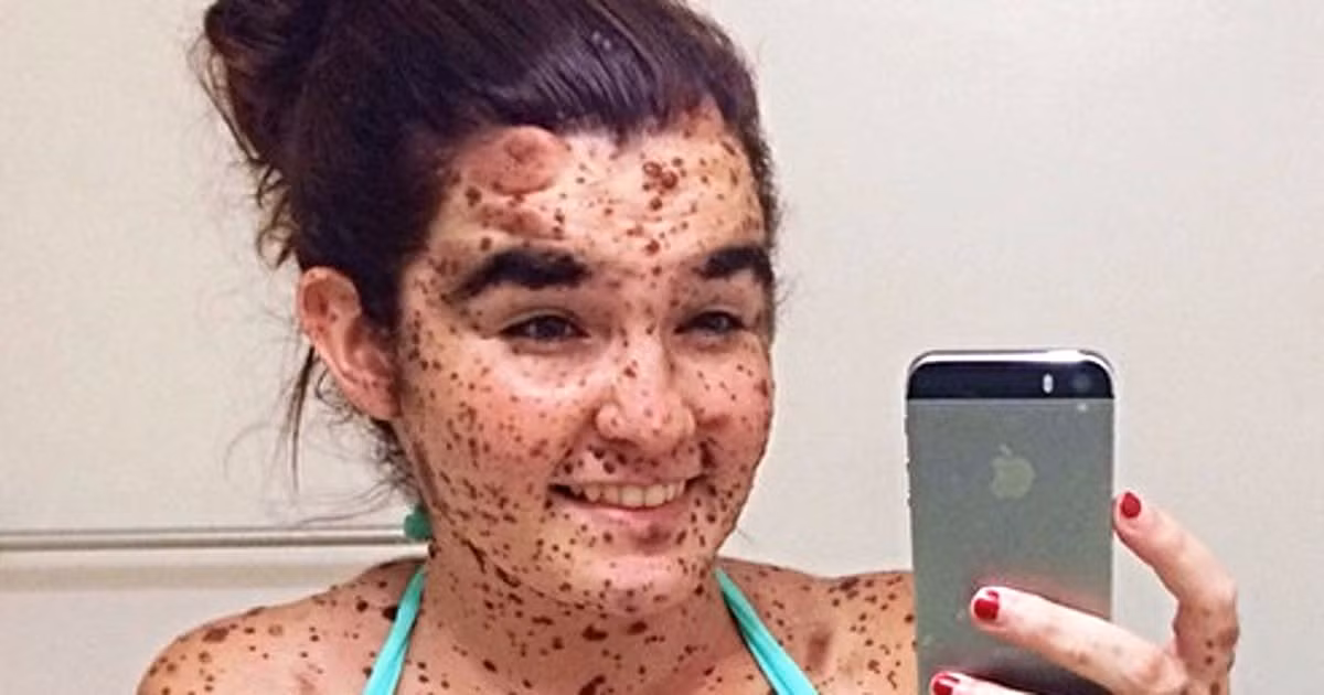 Ciera Swaringen là một bạn trẻ được sinh ra với một căn bệnh về da hiếm gặp đó là nevus melanocytic- trên cơ thể cô có khoảng hơn 100 vết bớt.