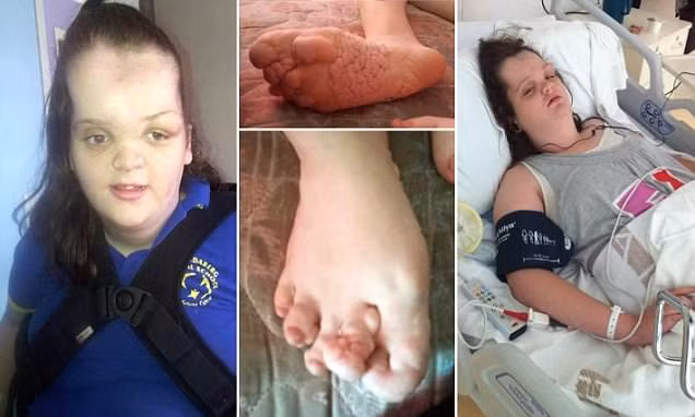 Tori Punch không thể đi lại và phải ngồi xe lăn bởi hội chứng Proteus - một trong những triệu chứng của căn bệnh "người voi". Hội chứng này khiến khiến chân và hộp sọ của cô bé phát triển không kiểm soát.