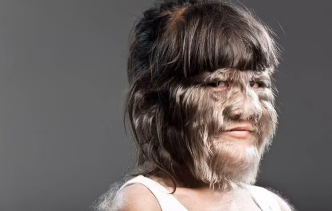 Supatra Sasuphan là cô gái có nhiều lông nhất trên thế giới. Kỷ lục bộ phận cơ thể người kỳ quặc nhất cũng luôn có tên của cô nàng. Mặc dù sinh ra với cơ thể cực kỳ nhiều lông nhưng Supatra không lấy làm buồn tủi vì bị mọi người kỳ thị, ngược lại "bộ lông làm tôi trở nên đặc biệt" là phương châm sống lạc quan của cô nàng.