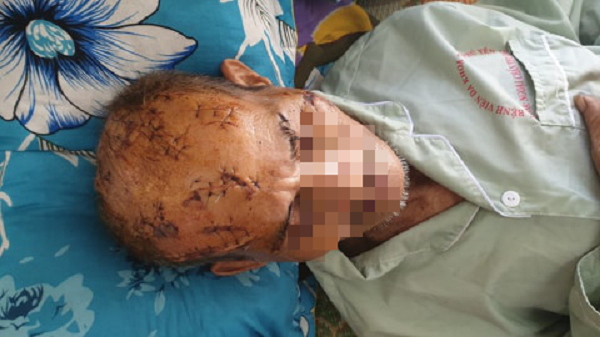 Ông T bị rạch chi chít các vết thương trên đầu