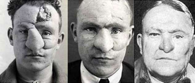 Ca phẫu thuật thí nghiệm phục chế khuôn mặt cho Đại úy William Spreckley (ảnh trên) được nhắc đến nhiều nhất, khi ông vốn đã bị thương nặng bởi nhiều mảnh đạn lên mặt, đặc biệt là phần mũi và má, vào tháng 1 năm 1971. Tiến sỹ Gillies đã lấy một phần sụn xương sườn của bệnh nhân và cấy vào khu vực trán bị tổn thương. Sau 6 tháng tiếp tục điều trị, Tiến sỹ lại lấy nó ra và dùng để tái tạo khuôn mũi. Sau 3 năm theo dõi và chăm sóc, tình trạng của Spreckley đã tiến triển thêm rất nhiều và có thể xuất viện.