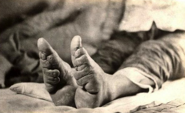 Bó chân là một phát minh về làm đẹp kém thú vị nhất trong danh sách này. Đây là 1 quá trình vô cùng đau đớn nhưng lại không đem lại bất kỳ 1 lợi ích nào khác ngoài làm đẹp. Thật may mắn vì giờ đây phương pháp làm đẹp này không còn được sử dụng nữa.