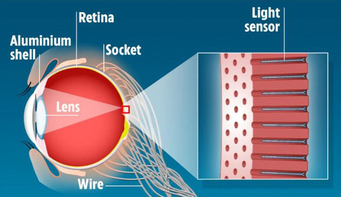 Cấu trúc của mắt bionic khi đưa vào bên trong giác mạc của con người.