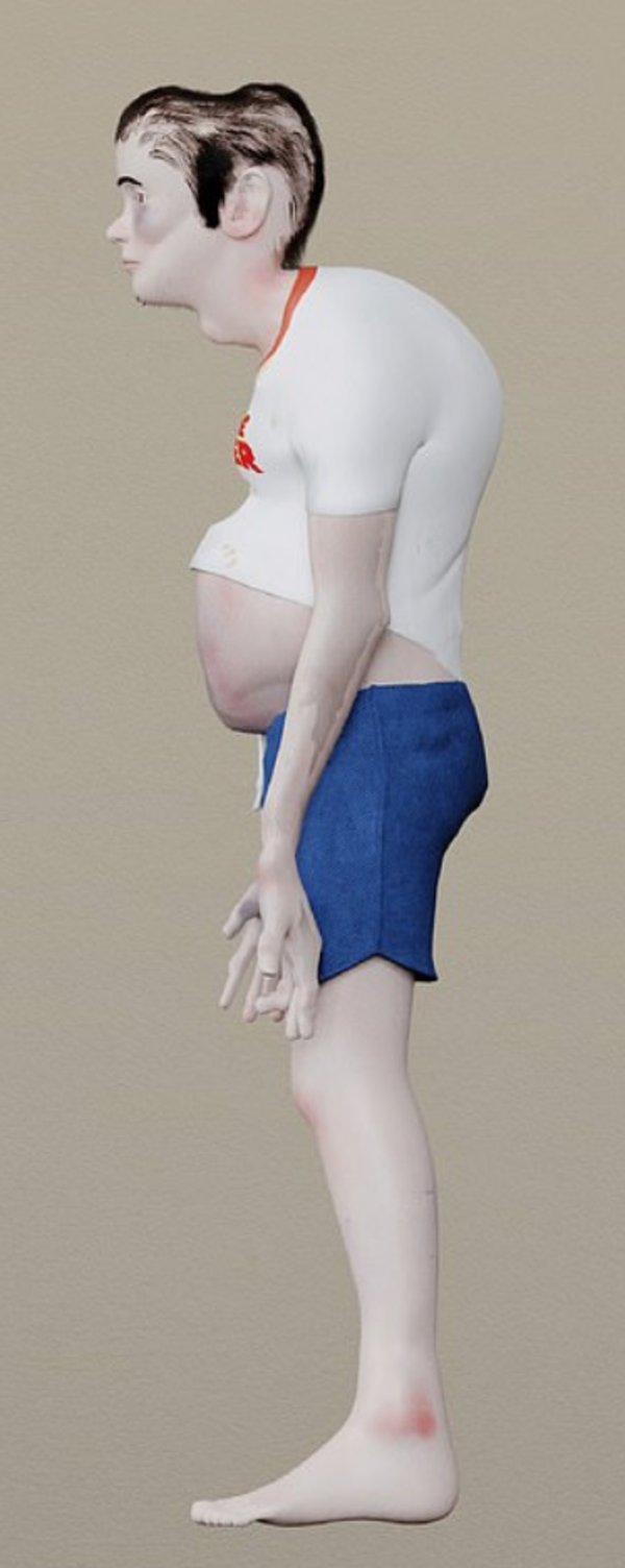 Lông mọc quanh tai do thiếu tuần hoàn, đây cũng là một cơ chế mà cơ thể đang tạo ra để bảo vệ khỏi bụi bẩn. Mái tóc không còn rậm rạp mà rụng nhiều do không ra ngoài hấp thụ ánh sáng mặt trời, thiếu vitamin D.