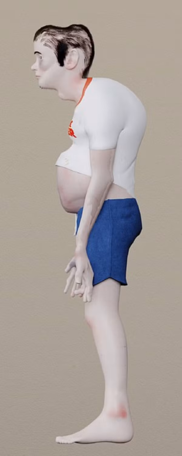 Lông mọc quanh tai do thiếu tuần hoàn, đây cũng là một cơ chế mà cơ thể đang tạo ra để bảo vệ khỏi bụi bẩn. Mái tóc không còn rậm rạp mà rụng nhiều do không ra ngoài hấp thụ ánh sáng mặt trời, thiếu vitamin D.