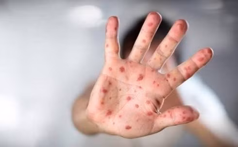 3 trieu chung som bao hieu benh tay chan mieng dien bien nang-Hinh-2