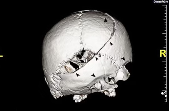 Ngoài ra, nhóm nghiên cứu phát hiện tất cả vết thương trên đầu của người đàn ông trẻ do cùng một loại vũ khí gây ra: có thể là thanh kiếm bằng thép.