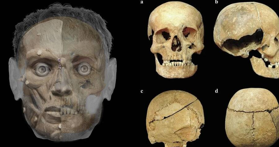 Nhóm của nhà nhân chủng học Chiara phân tích hài cốt của người đàn ông thời Trung cổ bằng kỹ thuật pháp y hiện đại bao gồm: chụp cắt lớp vi tính (CT), quét tia X 3 chiều, sử dụng kính hiển vi kỹ thuật số. Họ cũng xem xét vết thương ở hộp sọ.