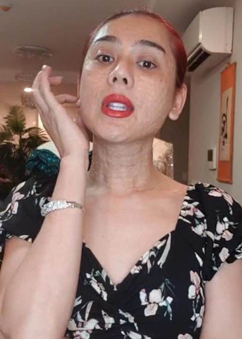 Đáp lại sự thắc mắc của người hâm mộ, nữ ca sĩ cho biết cô mới đi tân trang vùng mặt và cổ, hiện 2 vùng này vẫn còn sưng. Ảnh: Khám phá