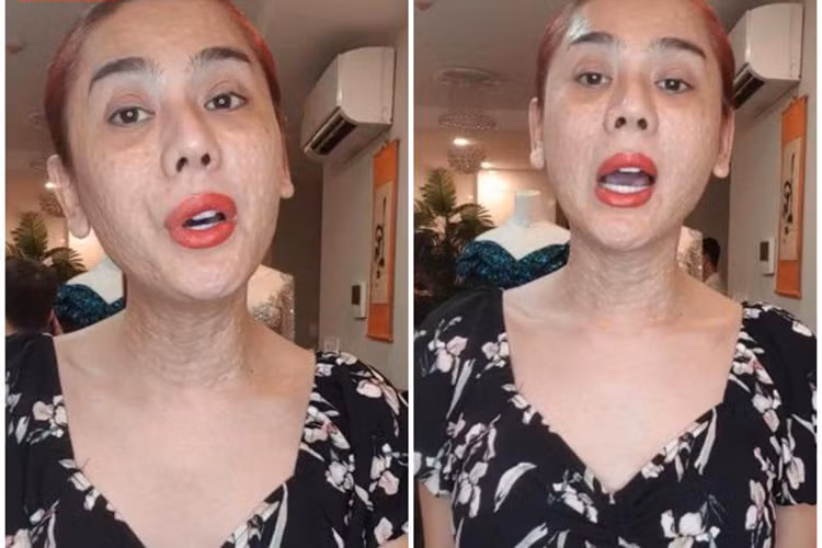 "Nữ hoàng chuyển giới" Lâm Khánh Chi đang khiến fan giật mình trước hình ảnh gương mặt nổi chi chít những đốm tròn. Ảnh: Khám phá