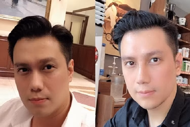 Gương mặt sau dao kéo của nam diễn viên Việt Anh đang trở thành đề tài bàn tán của dư luận. Nhiều người đặt nghi vấn anh đã gọt cằm, hút mỡ má, sửa mũi.