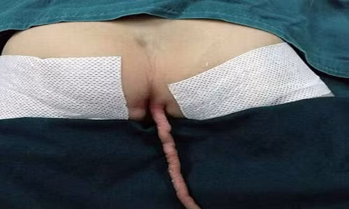 Cau be 11 thang tuoi co duoi tren nguoi dai 15 cm