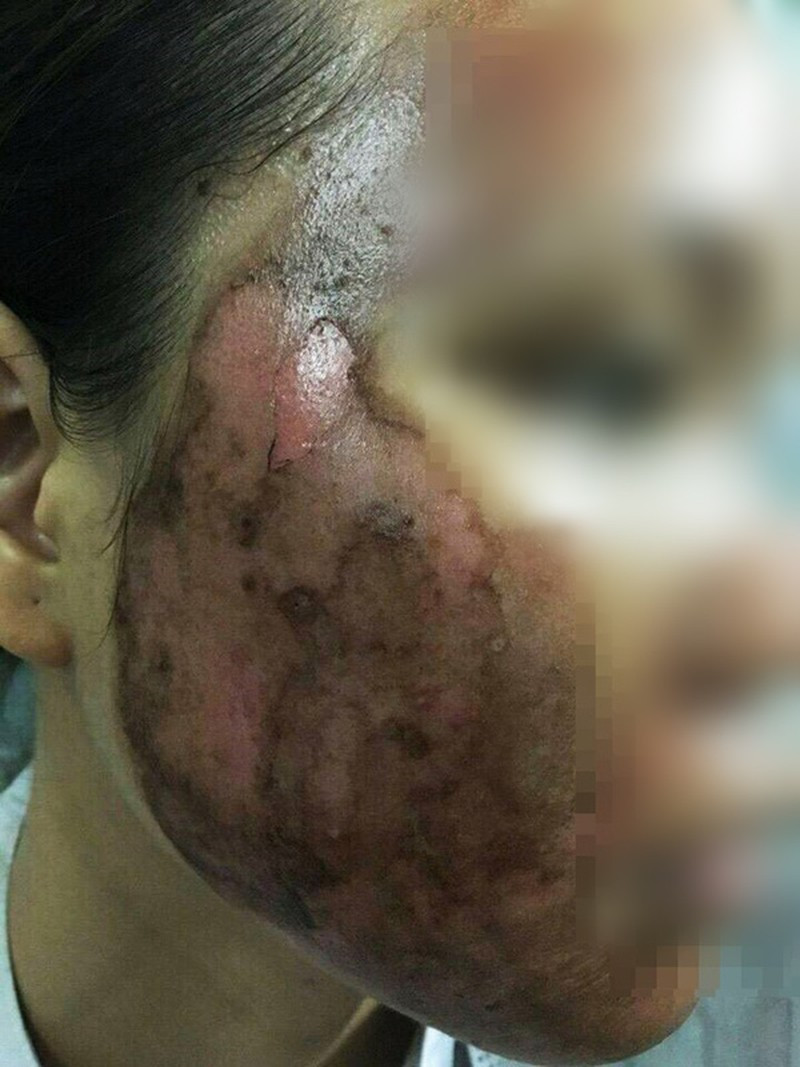 Năm 2017, một cô gái 23 tuổi ở Đồng Nai vì muốn “lột xác” đã mua mỹ phẩm được quảng cáo là thuốc đông y gia truyền với giá 2 triệu. Tuy nhiên, sau khi sử dụng thấy mặt ngày càng sưng, da ửng đỏ, phồng rộp. Cô gái đến bệnh viện cầu cứu và được xác định bỏng sâu cấp độ 2.