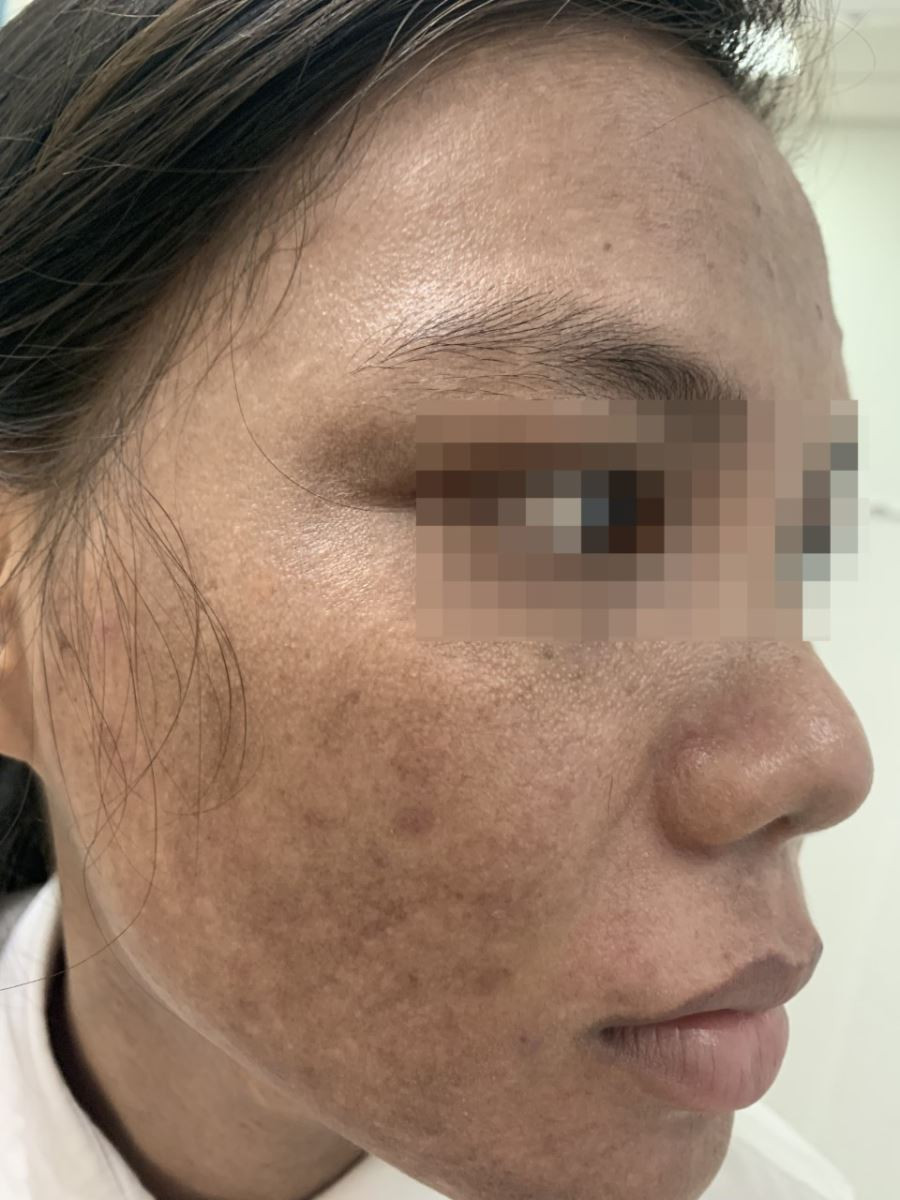 Hồi tháng 9/2019, chị T.P.T. (tỉnh Đăk Lăk) chưa tới 30 tuổi nhưng mặt đã xuất hiện nhiều vết nám. Do đó, chị T. lên mạng tìm hiểu và tự điều trị vết nám tại nhà bằng một loại kem trộn không rõ nguồn gốc được quảng cáo trên mạng. Sau vài ngày sử dụng chị T. bị ngứa rát nhẹ, bong vảy vùng mặt và cổ. Lo lắng vì tổn thương da mặt ngày càng nhiều, chị T. đã đến một spa ở gần nhà để điều trị và được cơ sở này cho một loại thuốc thoa không nhãn mác.