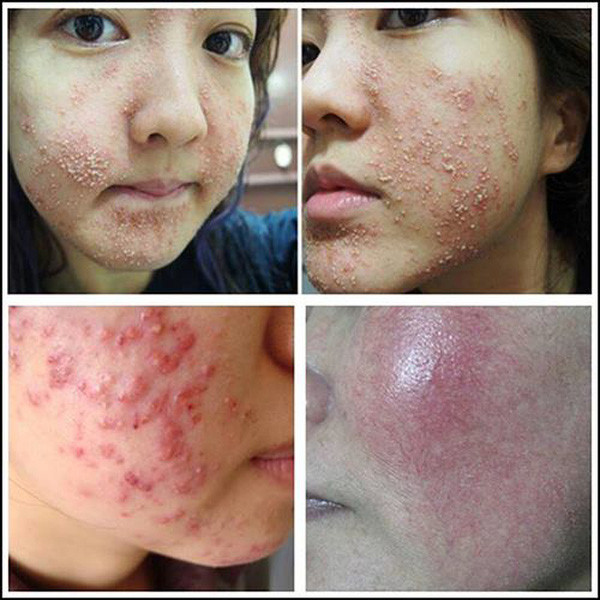 Bác sĩ Trần Nguyễn Ánh Tú - Trưởng Khoa Thẩm mỹ da Bệnh viện Da liễu TP.HCM cho biết, đa số trường hợp chị em muốn làm đẹp nhanh thường mua những sản phẩm làm trắng mà thành phần thường có là corticoid. Khi bị tổn thương, nếu chậm trễ điều trị, khả năng phục hồi rất lâu.