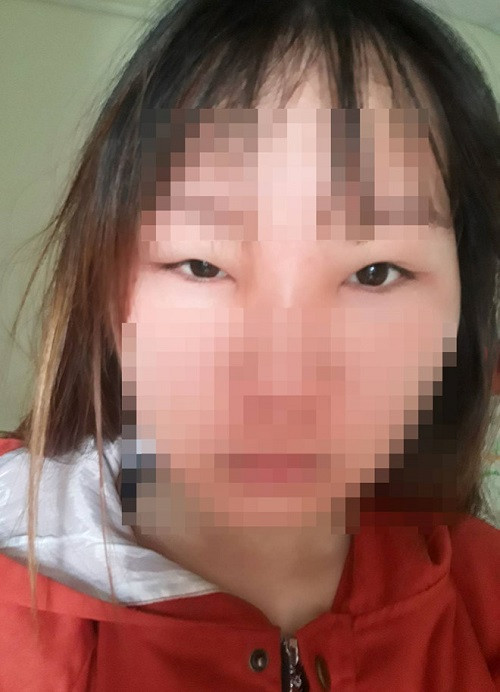 Sau khi bôi 2 lọ thuốc trị mụn, làm trắng da được quảng cáo là “Mỹ phẩm dân tộc” trong vòng một tháng, gương mặt của cô gái 19 tuổi bị biến dạng, sưng vù, mắt híp không mở nổi. Đó là trường hợp của Tâm (19 tuổi, quê Hà Tĩnh, tên nạn nhân đã được thay đổi).