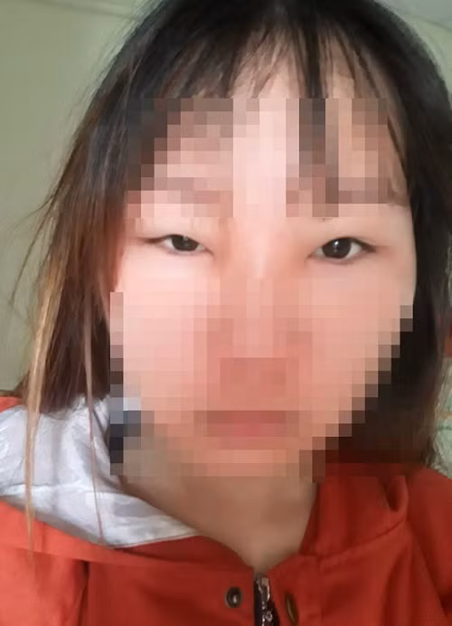 Sau khi bôi 2 lọ thuốc trị mụn, làm trắng da được quảng cáo là “Mỹ phẩm dân tộc” trong vòng một tháng, gương mặt của cô gái 19 tuổi bị biến dạng, sưng vù, mắt híp không mở nổi. Đó là trường hợp của Tâm (19 tuổi, quê Hà Tĩnh, tên nạn nhân đã được thay đổi).