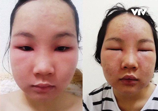 Một nữ bệnh nhân (mới 17 tuổi) đã phải chịu sự đau đớn khi dùng loại mỹ phẩm trôi nổi mua trên mạng với giá 65.000 đồng kèm lời quảng cáo sản phẩm lột thay da sinh học collagen. Tuy nhiên, đẹp chẳng thấy đâu, chỉ sau vài ngày sử dụng, bệnh nhân đã phải đến bệnh viện trong tình trạng da mặt sưng phù, đầy mụn mủ và chảy nước vàng. Ảnh: VTV.