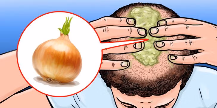 Dùng nước ép hành tây: Ép lấy một ít nước ép hoặc nghiền hành tây hành hỗn hợp sền sệt và thoa lên khắp da đầu, mùi của nó không dễ chịu cho lắm nhưng dung dịch hay hỗn hợp này thực sự có thể hỗ trợ giải quyết chứng hói đầu hiệu quả. Bởi nó có nhiều chất dinh dưỡng có lợi cho việc bảo vệ và phát triển các nang tóc, giúp tóc mọc nhanh, khỏe.