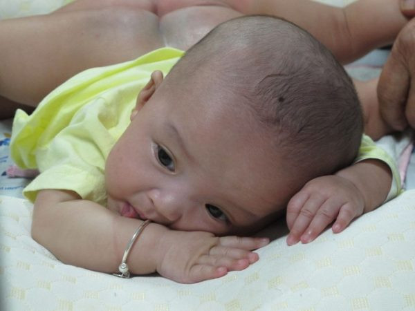 Hơn một năm qua, hai bé sống chung với rất nhiều bất tiện do tình trạng dính nhau. Sáu tháng tuổi, cặp song sinh biết ngồi dậy, bò chồm, học cách thay nhau bước lùi để tập di chuyển.