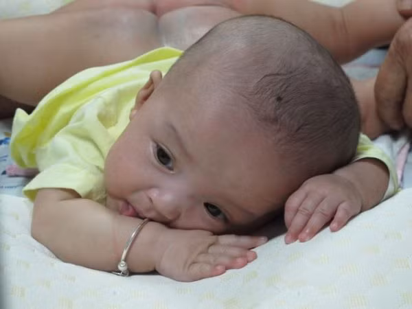 Hơn một năm qua, hai bé sống chung với rất nhiều bất tiện do tình trạng dính nhau. Sáu tháng tuổi, cặp song sinh biết ngồi dậy, bò chồm, học cách thay nhau bước lùi để tập di chuyển.