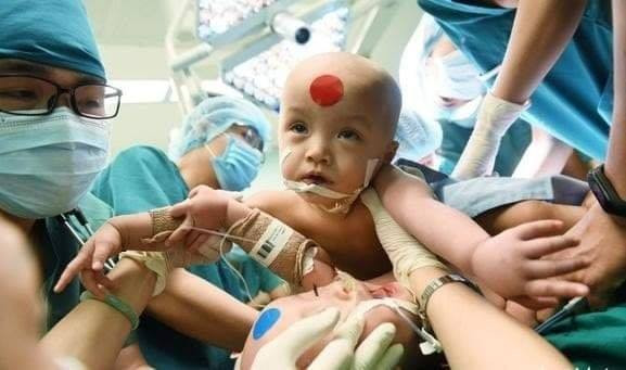 Đúng 18h40 chiều 15/7, cặp song sinh Trúc Nhi - Diệu Nhi đã được đưa ra khỏi phòng mổ sau khi các bác sĩ hoàn tất khâu tạo hình cuối cùng, khâu vết mổ, bó bột cho hai bé.