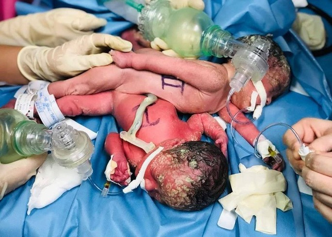 Sau sinh, hai bé được chuyển đến Bệnh viện Nhi đồng Thành phố điều trị các bệnh lý do sinh non, nhẹ cân.