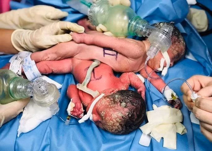 Sau sinh, hai bé được chuyển đến Bệnh viện Nhi đồng Thành phố điều trị các bệnh lý do sinh non, nhẹ cân.