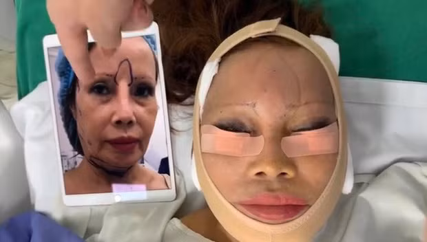 Thế nhưng, hình ảnh gương mặt biến dạng kinh hoàng sau phẫu thuật thẩm mỹ của chị Thu Sao khiến mọi người phát hoảng.