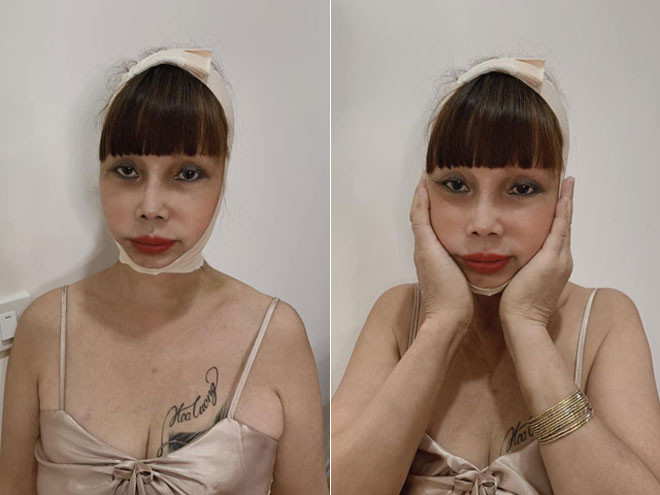 Diện mạo mới của cô dâu Thu Sao khiến dân mạng bất ngờ. Nhiều người bày tỏ lo lắng về sức khoẻ của chị khi liên tiếp thực hiện các ca phẫu thuật lớn, nhỏ ở tuổi ngoài 60. Sau khi tháo băng, khuôn mặt chị sưng phù, đỏ ửng, trông vô cùng đau đớn.