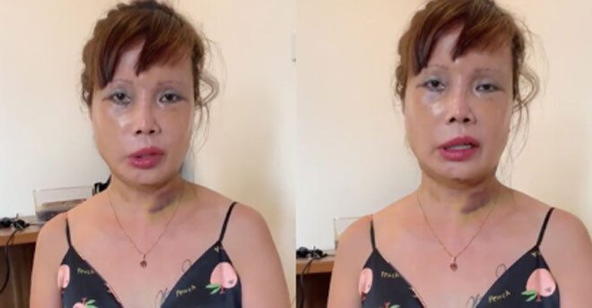 Trong đoạn video livestream mới đây, cô dâu Cao Bằng xuất hiện với khuôn mặt đã được tháo băng nhưng còn sẹo, làn da đỏ ửng, đôi mắt thâm tím và đặc biệt là chiếc miệng méo xệch.