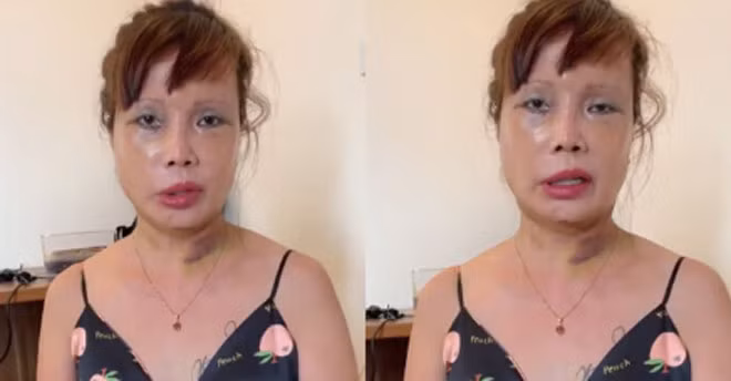 Trong đoạn video livestream mới đây, cô dâu Cao Bằng xuất hiện với khuôn mặt đã được tháo băng nhưng còn sẹo, làn da đỏ ửng, đôi mắt thâm tím và đặc biệt là chiếc miệng méo xệch.