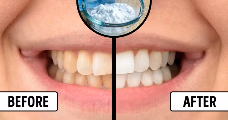 Trộn lẫn 1 thìa baking soda với một ít nước cốt chanh, dùng bông chấm vào hỗn hợp rồi lau lên răng của bạn. Để hỗn hợp trên răng khoảng 2 phút rồi dùng súc miệng kỹ lại với nước sạch. Thực hiện 2 lần/tuần để có hàm răng trắng sáng.