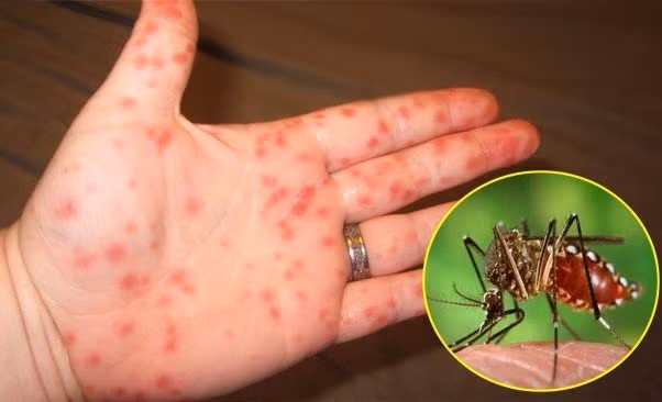 Sốt xuất huyết ở Hà Nội: Làm gì để phòng bệnh? Sot xuat huyet o Ha Noi: Lam gi de phong benh?