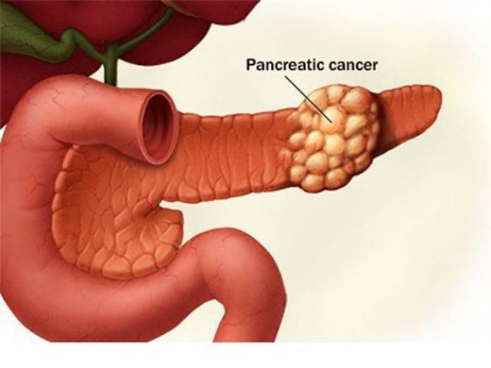 Hiện không có biện pháp phòng ngừa ung thư tuyến tụy, tuy nhiên, việc giảm thiểu các yếu tố nguy cơ là rất quan trọng. Một số biện pháp như không hút thuốc lá, không rượu bia có thể làm giảm nguy cơ mắc căn bệnh này.
