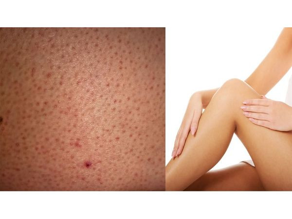 Da sần sùi: Hàm lượng vitamin C thấp gây ra bệnh viêm giác mạc. Đây là một loại tình trạng làm cho da mấp mô phát triển ở mặt sau của cánh tay trên, đùi hoặc mông do sự tích tụ protein keratin bên trong lỗ chân lông.