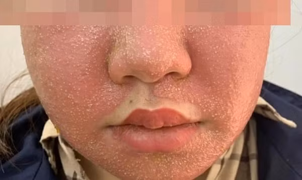 Đắp mặt nạ đông y trắng da, mặt mọc đầy mụn mủ kinh hoàng Dap mat na dong y trang da, mat moc day mun mu kinh hoang