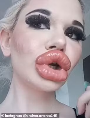 Andrea Emilova Ivanova nói: "Tôi thấy rất tuyệt khi được tiêm dày hơn nhưng một số bác sĩ lại nghĩ rằng thế là đủ rồi. Bác sĩ của tôi bảo sẽ tiêm thêm cho tôi nhưng phải đợi ít nhất hai tháng nữa".