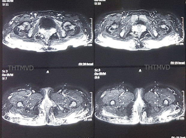 Bom mo nang cap “vong 3”, co gai bi hoai tu mong phuc tap