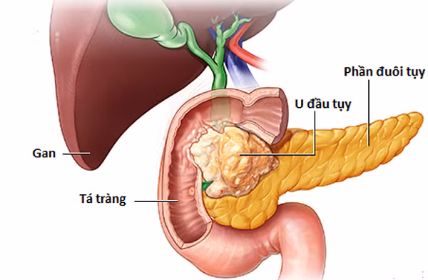 NS Pho Duc Phuong qua doi: Ung thu tuy 