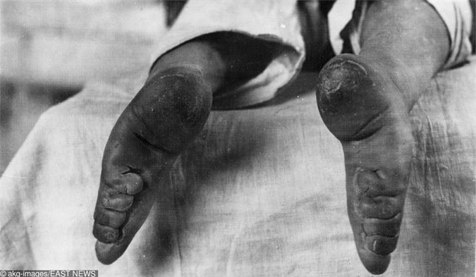 Để có được đôi "gót sen" hoàn hảo, người mẹ hoặc người bà trong gia đình sẽ bắt đầu bó chân con gái, cháu gái họ khi đứa trẻ 2 - 5 tuổi - khoảng thời gian xương bàn chân chưa phát triển hoàn thiện.