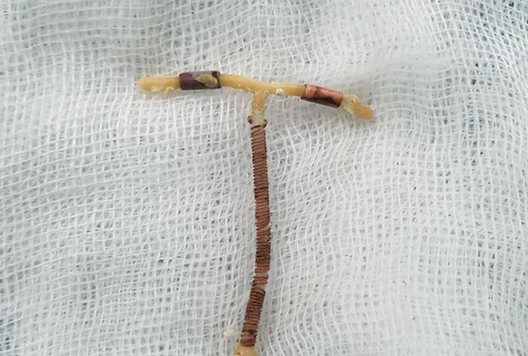 Vong tranh thai dam thung truc trang: Nhung tai nan dang so khac-Hinh-3